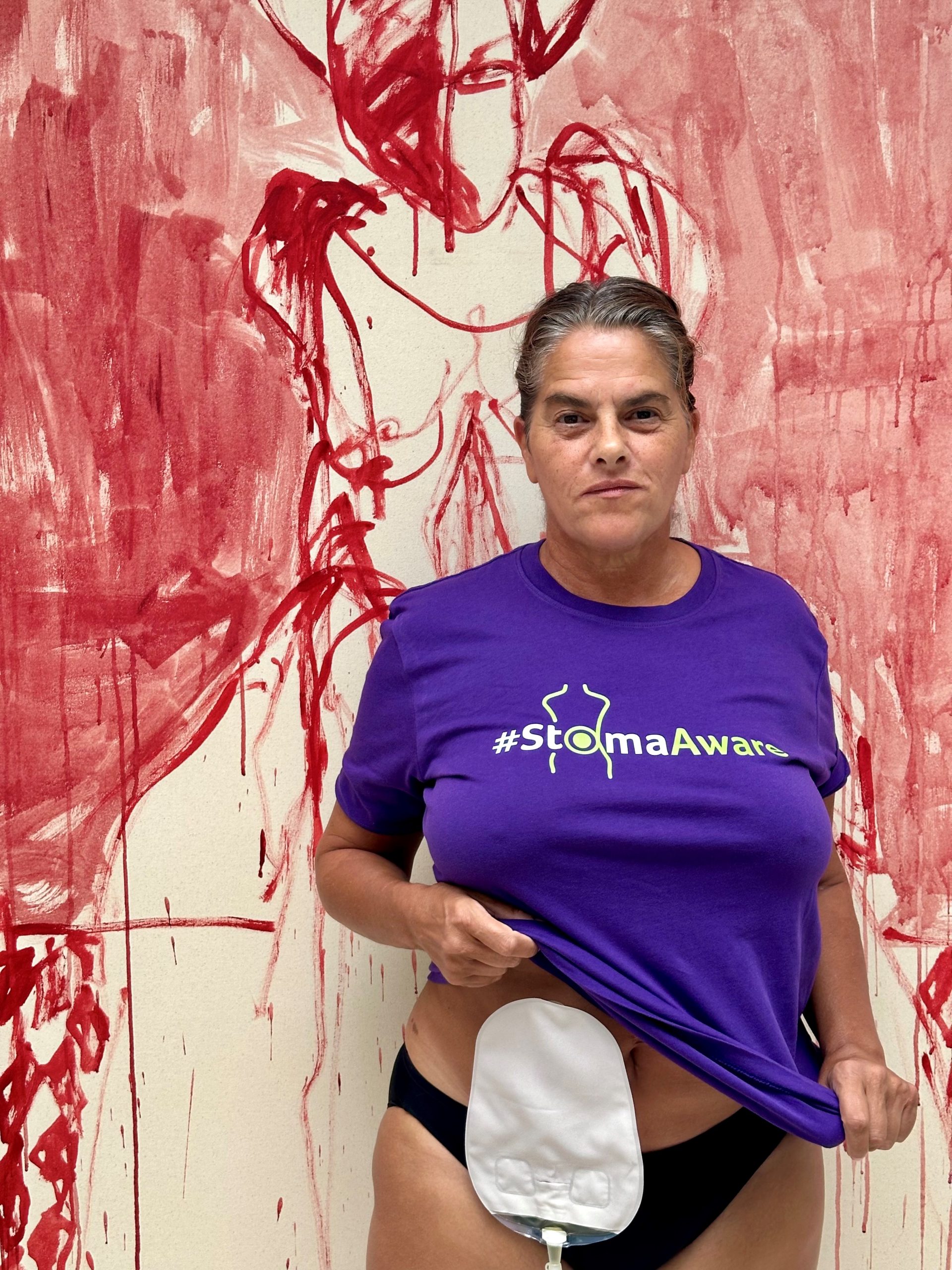 Smash Social Exclusion If I ask for a different type of chair, people think  I'm being a diva - EXCLUSIVE - Tracey Emin on Living with a Stoma -  Colostomy UK